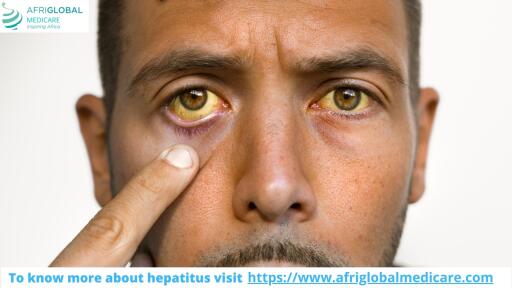 Symptoms of Hepatitis