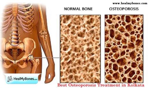 Best Osteoporosis Doctor in Kolkata: Dr. Manoj Kumar Khemani