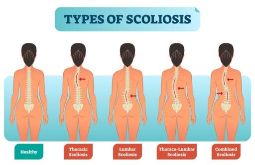 Scoliosis Treatment Boise, ID
