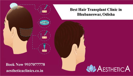 Best Hair Transplant Clinic in Bhubaneswar