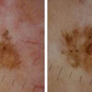 Skin Cancer|http://www.sandgatedoctors.com.au/